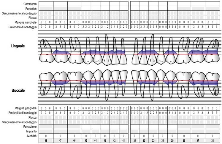 Tarquini_Periodontal intrabony defect